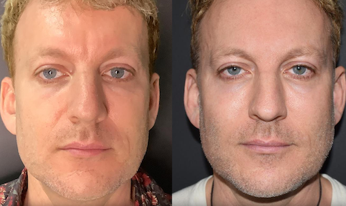 Jawline Thread Lift Before After Mississauga Oakville